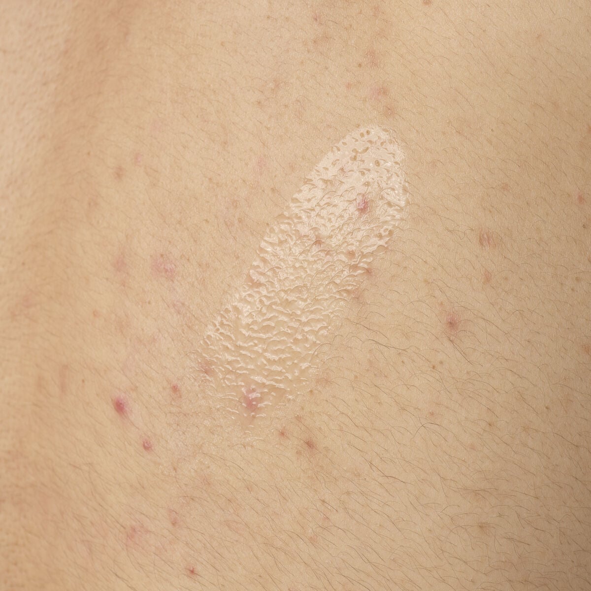 salicylic-acid-0-5-body-serum-f5 ORD-salicylic-acid-05-body-240ml-application.jpg