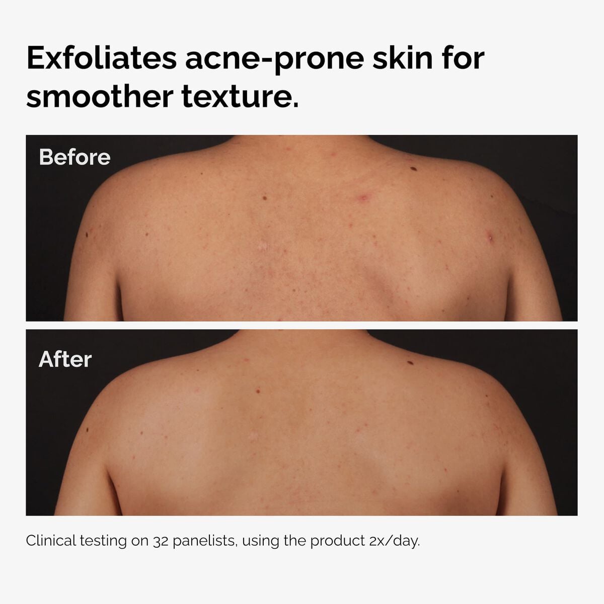 salicylic-acid-0-5-body-serum-f5 ord-salicylic-acid-body-serum-before-after-graphic-NA.jpg