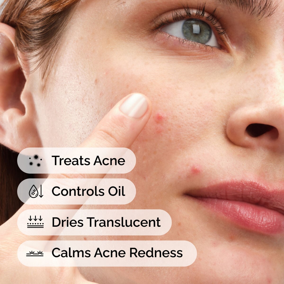 sulfur-10-powder-to-cream-concentrate-e2 ord-sulfur-10pct-powder-to-cream-concentrate-model-application-with-benefits-acne.jpg